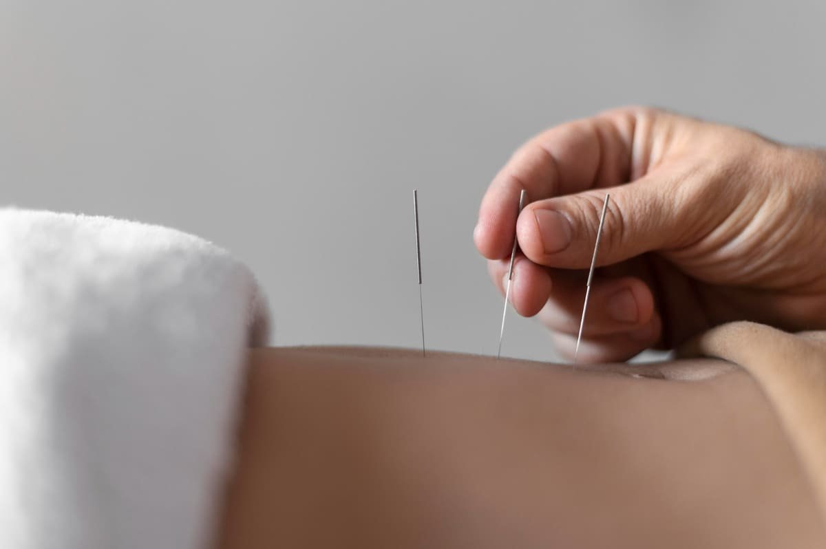 Beneficios de la Acupuntura en Querétaro para tu bienestar físico y emocional